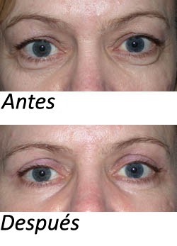 Blefaroplastia