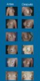 Mamoplastia de aumento