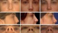 Rinoplastia