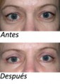 Blefaroplastia
