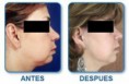 Ritidoplastia